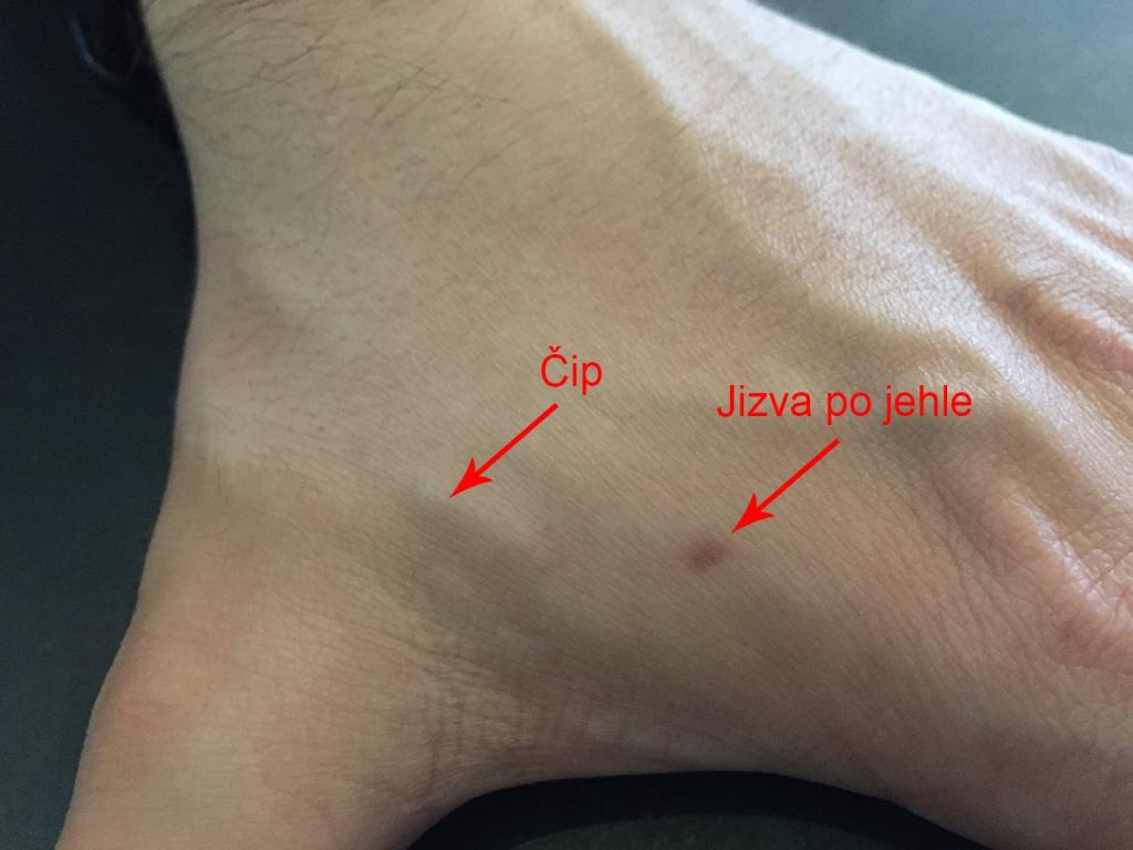 Mikročip obsahující informace o vašem očkovacím pasu lze dnes vložit rovnou do vaší&nbsp;paže